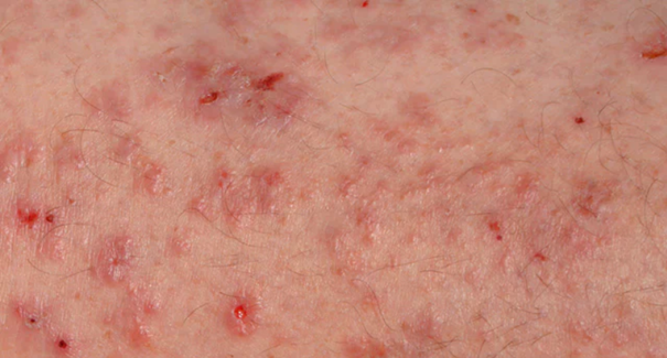 Ist das Krätze? starker Drang zu Kratzen und ausgeprägtem Juckreiz .
Hautrötungen und Kratzspuren,
kaputte Haut, nervenaufreibend wegen der Juckerei,Neurodermitis,